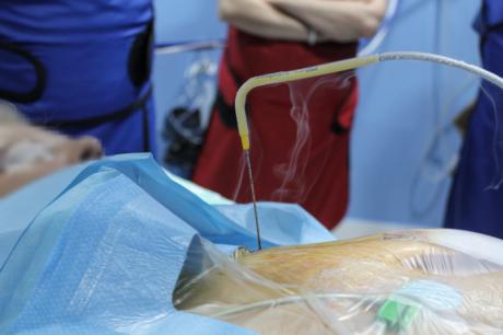 El Hospital de Toledo incorpora una nueva técnica de tratamiento mínimamente invasiva para los nódulos tumorales de pulmón