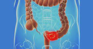 El Programa regional de Detección Precoz de Cáncer Colorrectal mejorará su diagnóstico con novedades en su desarrollo logístico a partir de otoño