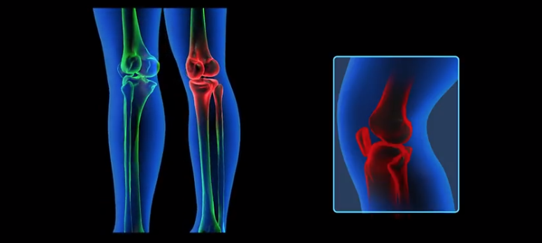 El Hospital Recoletas ofrece prótesis de rodilla personalizadas a cada paciente, realizadas a partir de un sistema de impresión 3d